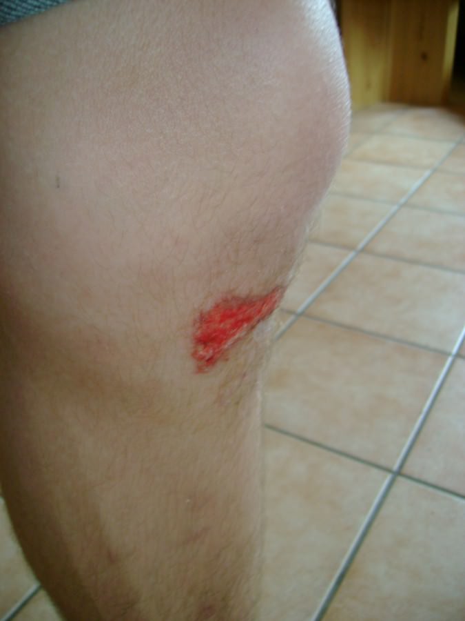 So sehe ich nach dem Unfall aus