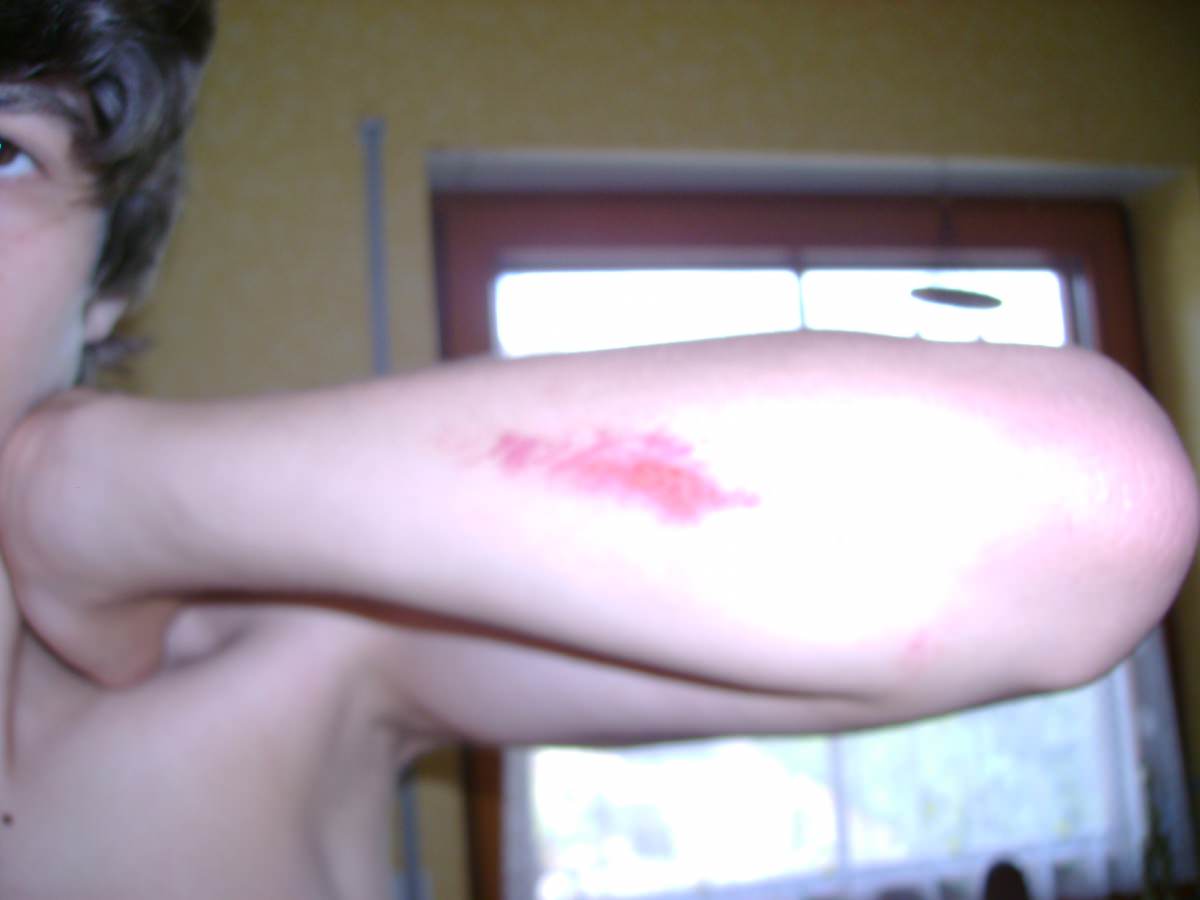 So sehe ich nach dem Unfall aus