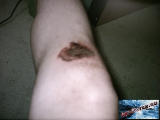 Mein knie... nach unfall